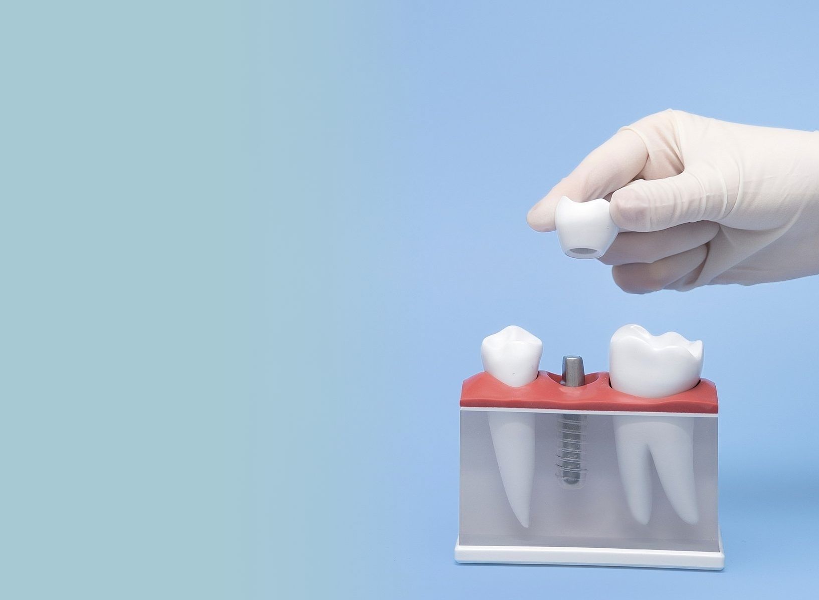 インプラント イメージ