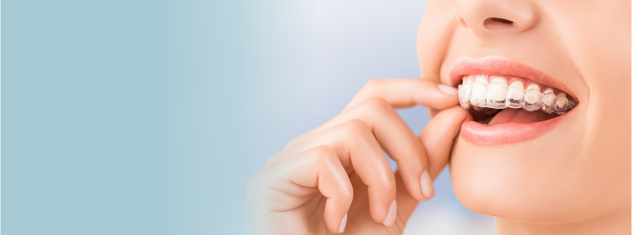 インビザライン イメージ