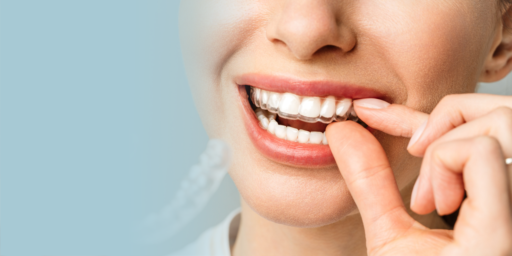 マウスピース矯正 イメージ